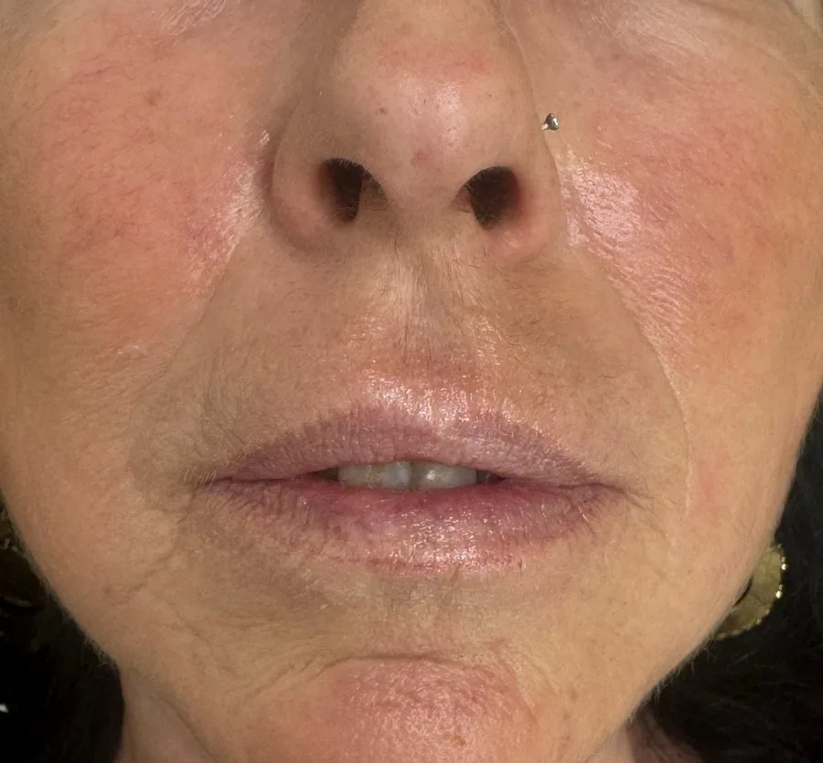 Filler labbra: prima del trattamento, caso 6