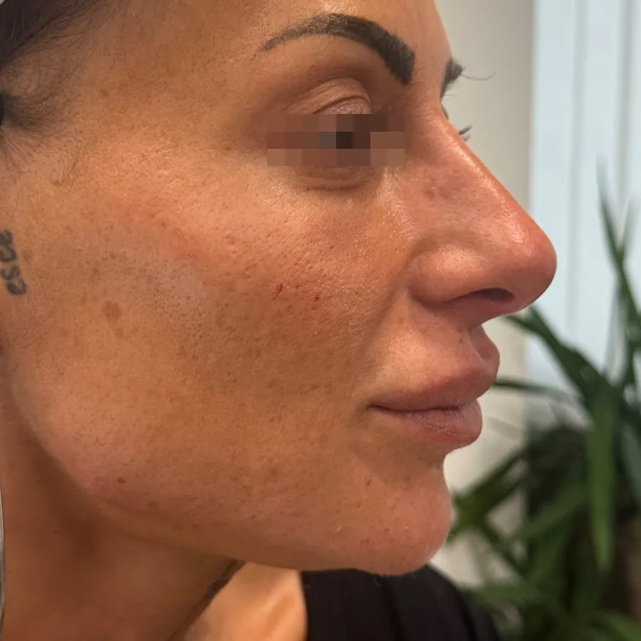Filler mento e profiloplastica mandibolare: prima del trattamento, caso 2