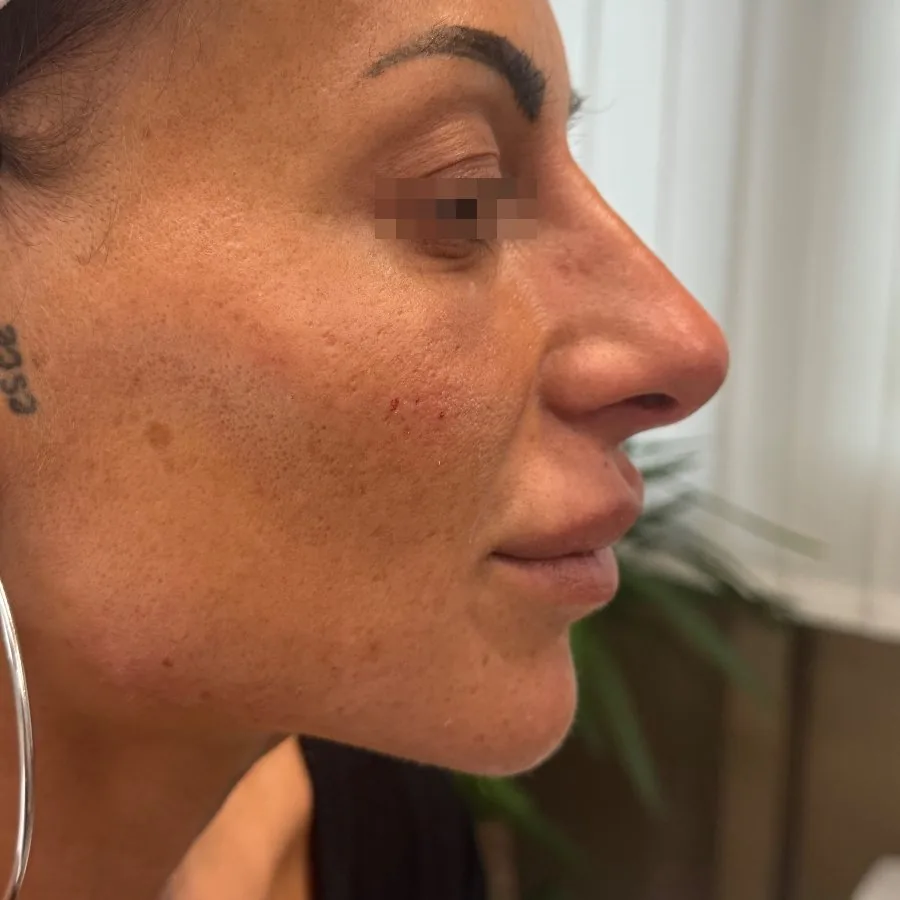 Filler mento e profiloplastica mandibolare: dopo il trattamento, caso 2