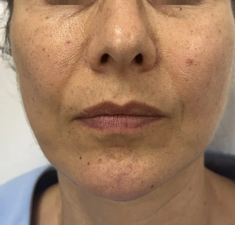 Filler mento e profiloplastica mandibolare: dopo il trattamento, caso 1