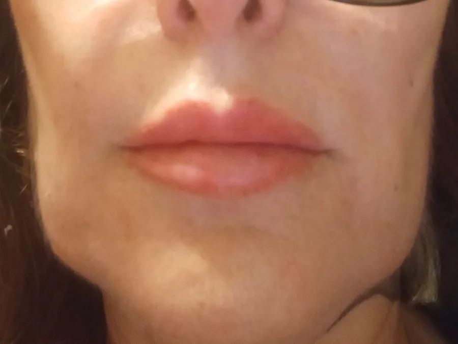 Filler labbra: dopo il trattamento, caso 5