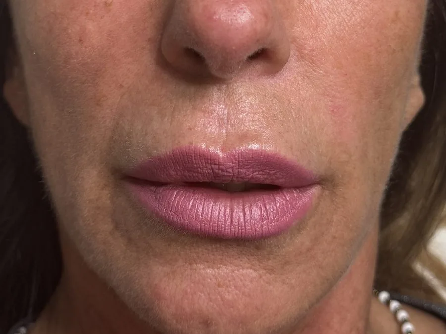 Filler labbra: prima del trattamento, caso 4