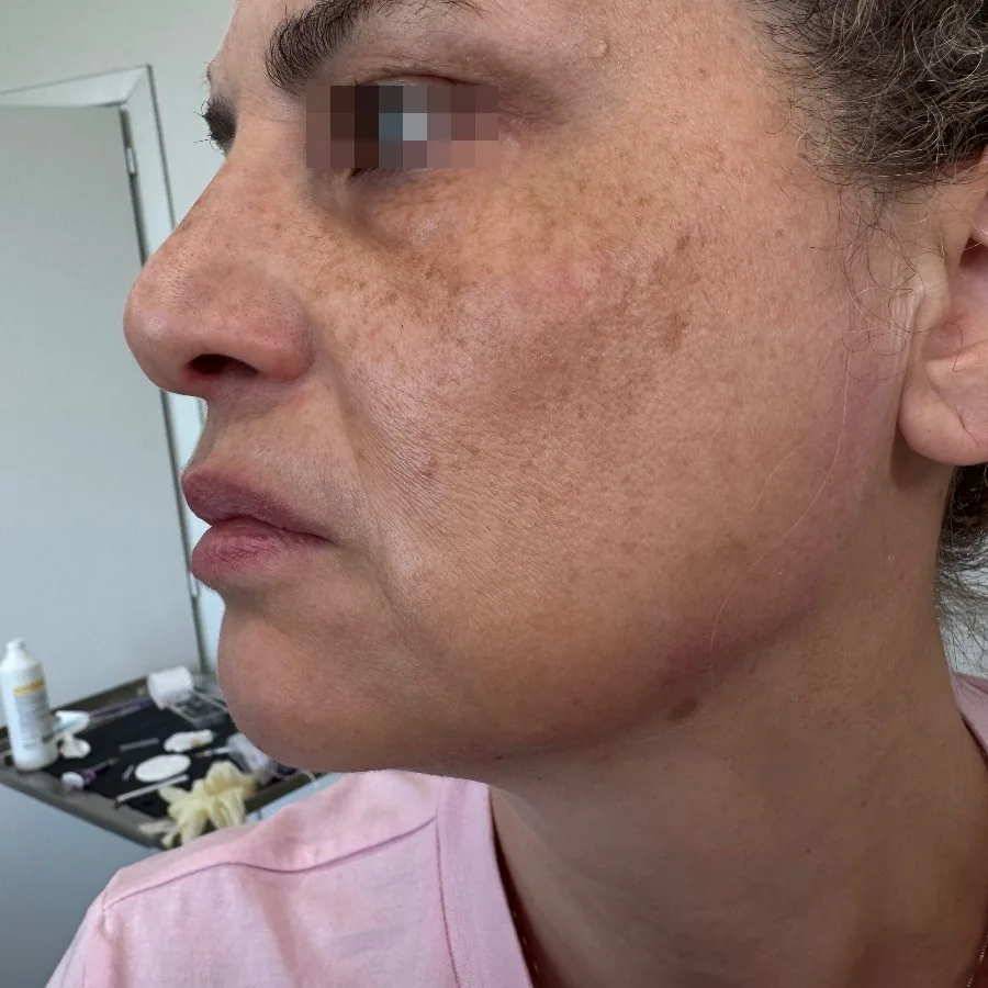 Filler mento e profiloplastica mandibolare: prima del trattamento, caso 4