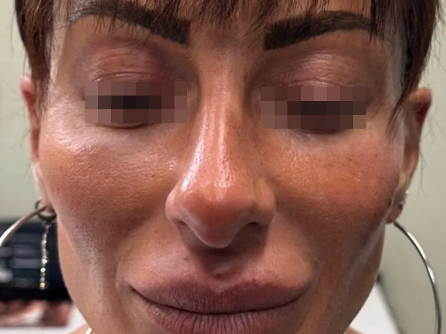 Filler zigomi: dopo il trattamento, caso 2
