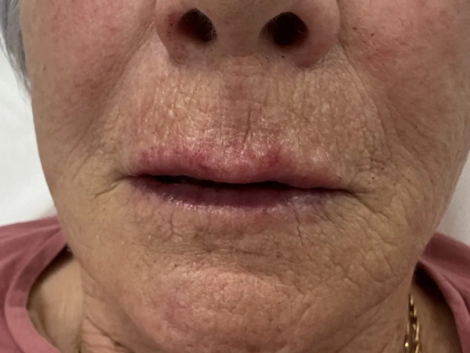 Filler labbra: dopo il trattamento, caso 1