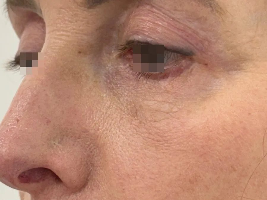 Filler occhiaie: prima del trattamento, caso 1