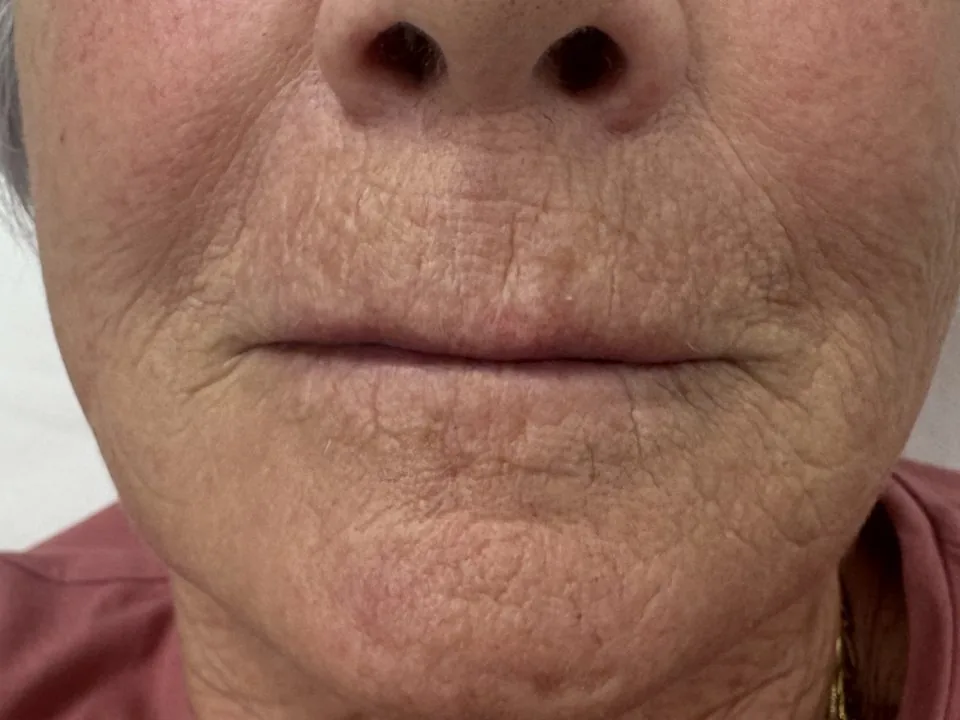 Filler labbra: prima del trattamento, caso 1