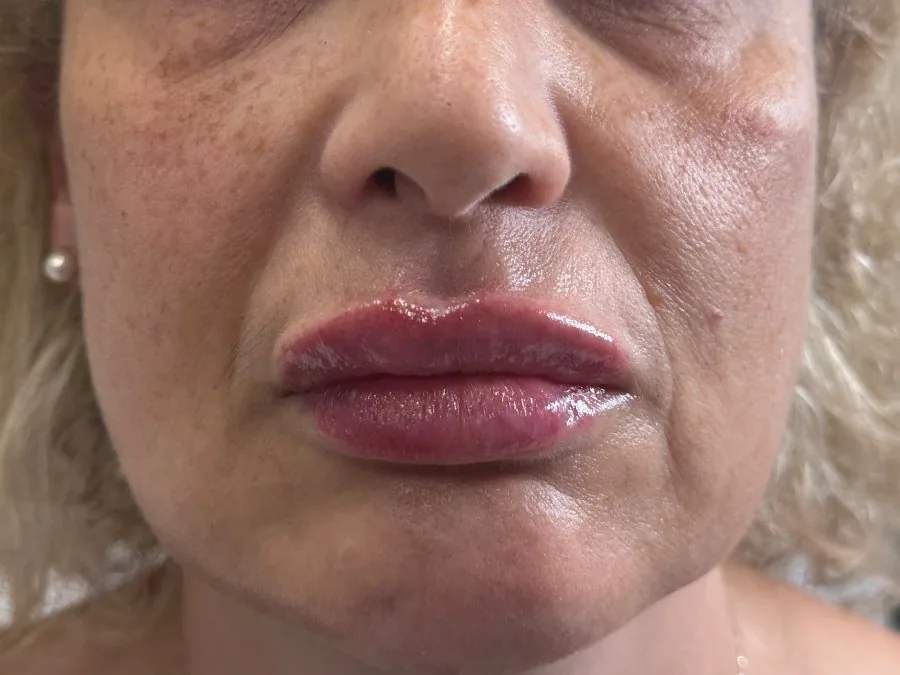 Filler labbra: dopo il trattamento, caso 8