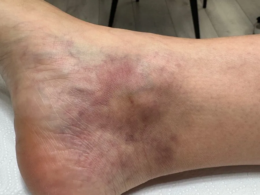 Scleroterapia dei capillari: dopo il trattamento, caso 1
