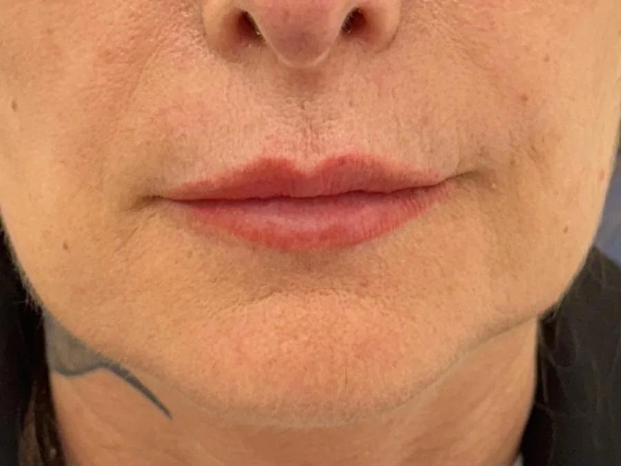 Filler labbra: prima del trattamento, caso 5