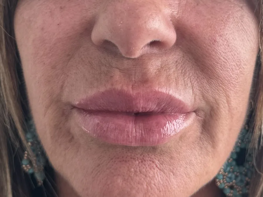Filler labbra: dopo il trattamento, caso 4