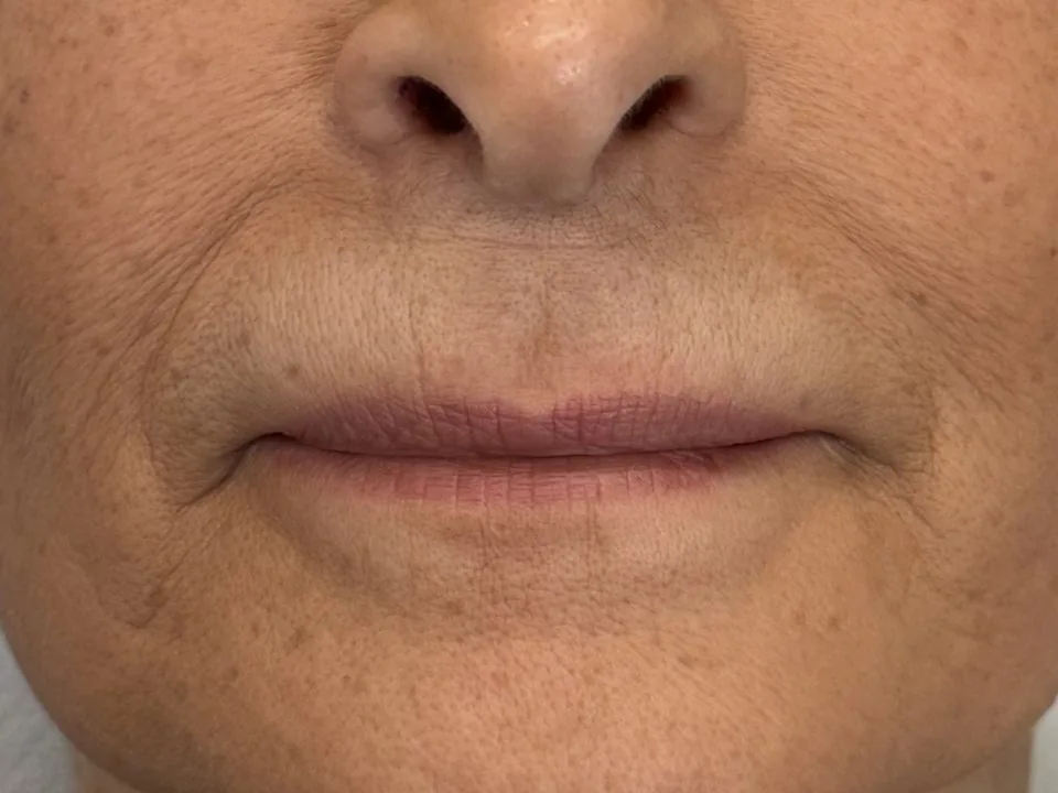 Filler labbra: prima del trattamento, caso 3
