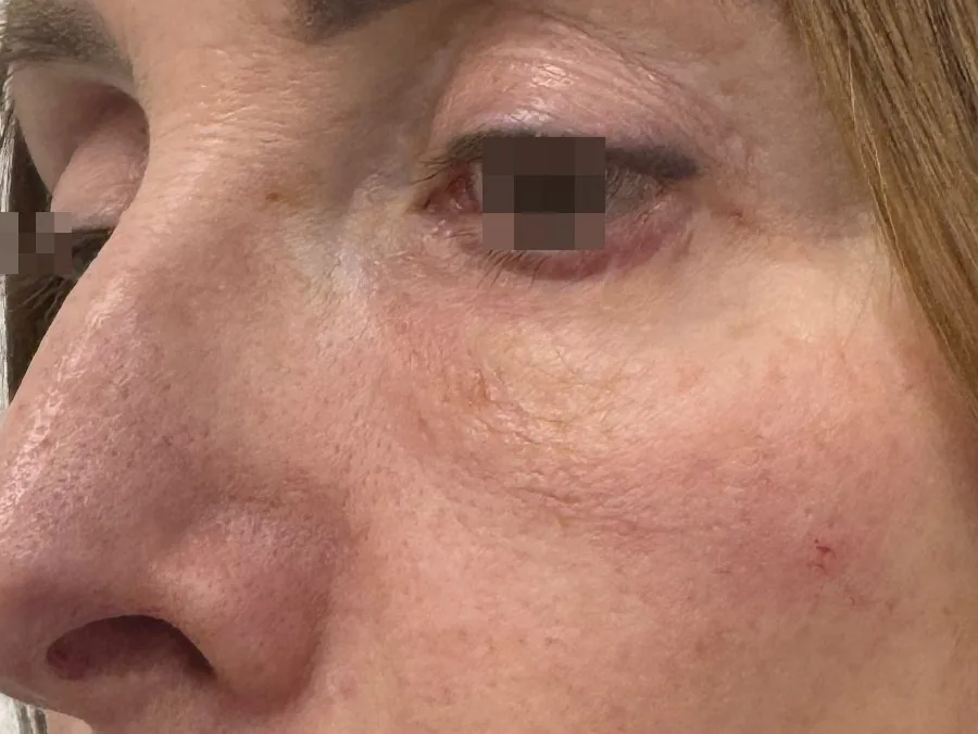 Filler occhiaie: dopo il trattamento, caso 1