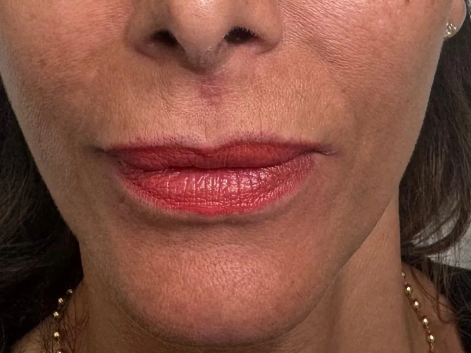 Filler labbra: prima del trattamento, caso 2
