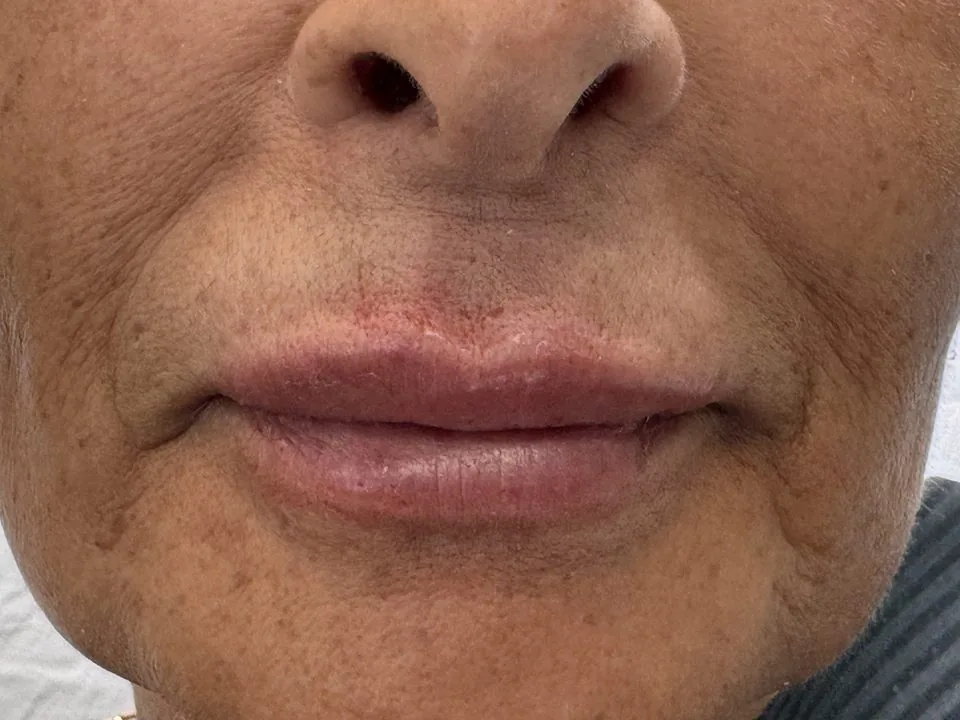 Filler labbra: dopo il trattamento, caso 3